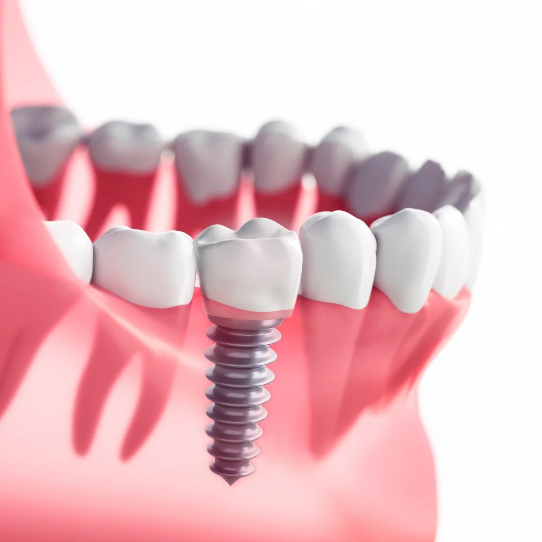 Dental implant placement at Glendale Dental Wellness